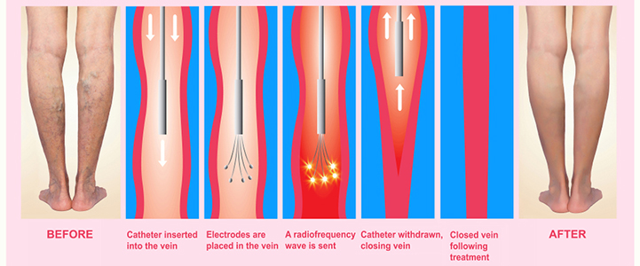 blog-ablation
